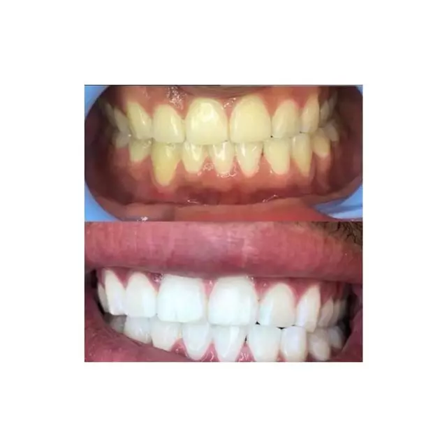 Lux Teeth Whitening