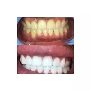 Lux Teeth Whitening